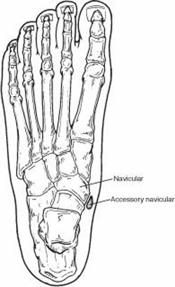 accessory navicular syndrome