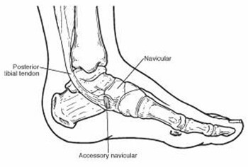 accessory navicular syndrome