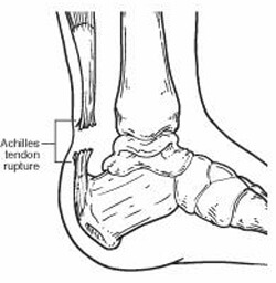 aachilles tendon rupture