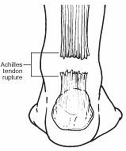 aachilles tendon rupture