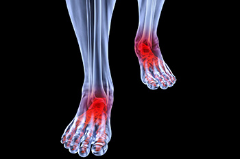 Arthritic foot and ankle care treatment in the Anne Arundel County, MD: Glen Burnie (Linthicum Heights, Ferndale, Severn, Pasadena, Jacobsville, Gambrills, Curtis Bay, Riviera Beach, Odenton, Fort Meade, Patapsco, Hanover, Millersville, Brooklyn Park) areas
