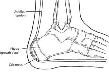 calcaneal-apophysitis