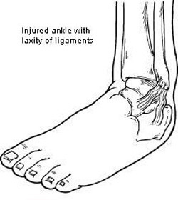 chronic ankle instability