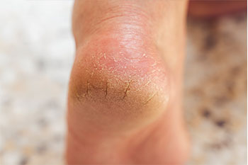 Remedies for cracked heels in the Anne Arundel County, MD: Glen Burnie (Linthicum Heights, Ferndale, Severn, Pasadena, Jacobsville, Gambrills, Curtis Bay, Riviera Beach, Odenton, Fort Meade, Patapsco, Hanover, Millersville, Brooklyn Park) areas