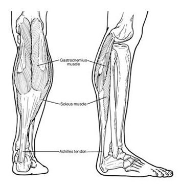 equinus