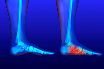 Flat Feet Treatment in the Anne Arundel County, MD: Glen Burnie (Linthicum Heights, Ferndale, Severn, Pasadena, Jacobsville, Gambrills, Curtis Bay, Riviera Beach, Odenton, Fort Meade, Patapsco, Hanover, Millersville, Brooklyn Park) areas