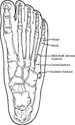fractures of the fifth metatarsal