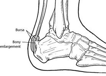 Haglunds deformity treatment in the Anne Arundel County, MD: Glen Burnie (Linthicum Heights, Ferndale, Severn, Pasadena, Jacobsville, Gambrills, Curtis Bay, Riviera Beach, Odenton, Fort Meade, Patapsco, Hanover, Millersville, Brooklyn Park) areas