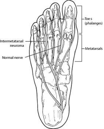 Mortons' neuroma Treatment in the Anne Arundel County, MD: Glen Burnie (Linthicum Heights, Ferndale, Severn, Pasadena, Jacobsville, Gambrills, Curtis Bay, Riviera Beach, Odenton, Fort Meade, Patapsco, Hanover, Millersville, Brooklyn Park) areas