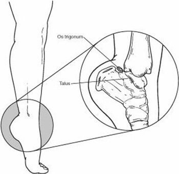 os trigonum syndrome