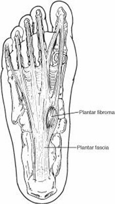 plantar fibroma