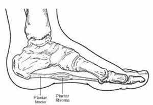 plantar fibroma