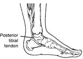 posterior tibial tendon dysfunction