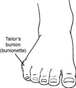 Tailor's Bunion treatment in the Anne Arundel County, MD: Glen Burnie (Linthicum Heights, Ferndale, Severn, Pasadena, Jacobsville, Gambrills, Curtis Bay, Riviera Beach, Odenton, Fort Meade, Patapsco, Hanover, Millersville, Brooklyn Park) areas