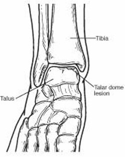 talar dome lesion