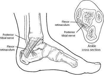 Tarsal tunnel syndrome in the Anne Arundel County, MD: Glen Burnie (Linthicum Heights, Ferndale, Severn, Pasadena, Jacobsville, Gambrills, Curtis Bay, Riviera Beach, Odenton, Fort Meade, Patapsco, Hanover, Millersville, Brooklyn Park) areas