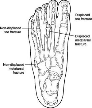 Toe and metatarsal fractures in the Anne Arundel County, MD: Glen Burnie (Linthicum Heights, Ferndale, Severn, Pasadena, Jacobsville, Gambrills, Curtis Bay, Riviera Beach, Odenton, Fort Meade, Patapsco, Hanover, Millersville, Brooklyn Park) areas