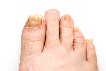 Toenail fungus, fungal infection, fungal nails diagnosis and treatment in the Anne Arundel County, MD: Glen Burnie (Linthicum Heights, Ferndale, Severn, Pasadena, Jacobsville, Gambrills, Curtis Bay, Riviera Beach, Odenton, Fort Meade, Patapsco, Hanover, Millersville, Brooklyn Park) areas