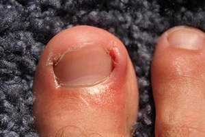The Importance of Proper Toenail Trimming