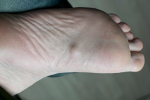 Definition and Causes of a Plantar Fibroma