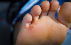 Surgery May Relieve Painful Corns