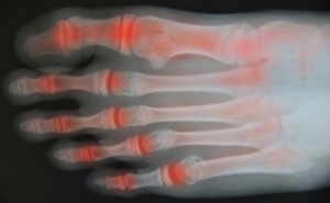 Can Osteoarthritis Occur in the Ankles?