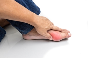 Facts About Gout Attacks